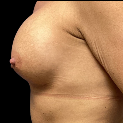 Breast Augmentation Before & After Patient #4725