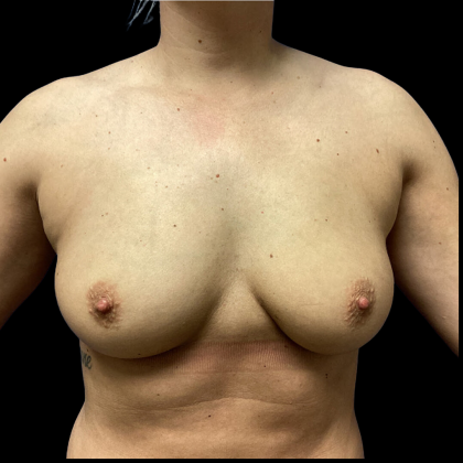 Breast Augmentation Before & After Patient #4726