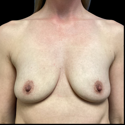 Breast Augmentation Before & After Patient #4714