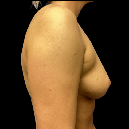 Breast Augmentation Before & After Patient #4726