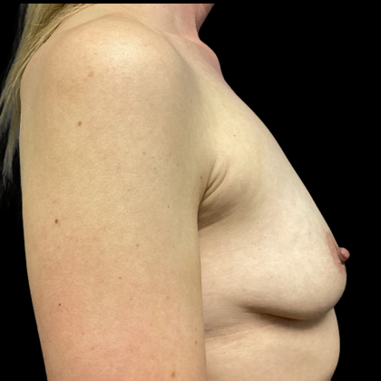 Breast Augmentation Before & After Patient #4714