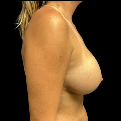 Breast Augmentation Before & After Patient #4726