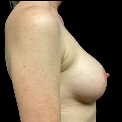 Breast Augmentation Before & After Patient #4714