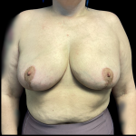 Breast Reduction Before & After Patient #4715