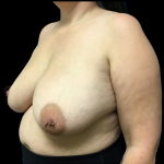 Breast Reduction Before & After Patient #4715