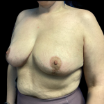 Breast Reduction Before & After Patient #4715