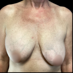 Implant Removal Before & After Patient #4716