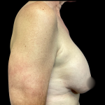 Implant Removal Before & After Patient #4716