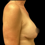 Implant Removal Before & After Patient #4716