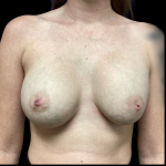 Implant Removal Before & After Patient #4727