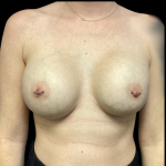 Implant Removal Before & After Patient #4727
