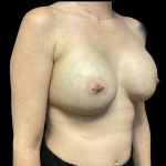 Implant Removal Before & After Patient #4727