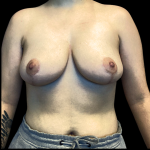 Breast Reduction Before & After Patient #4717