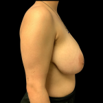 Breast Reduction Before & After Patient #4717