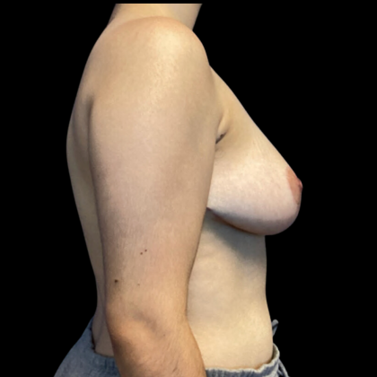 Breast Reduction Before & After Patient #4717
