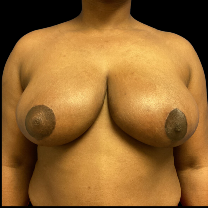 Breast Reduction Before & After Patient #4718