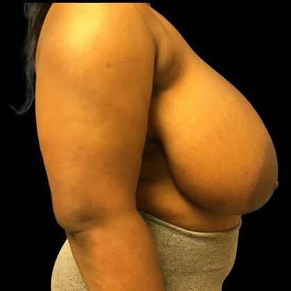 Breast Reduction Before & After Patient #4718