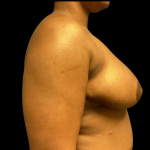 Breast Reduction Before & After Patient #4718