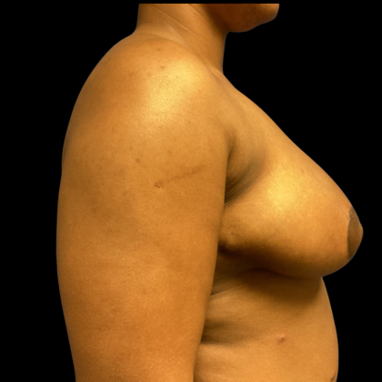 Breast Reduction Before & After Patient #4718