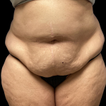 Tummy Tuck Before & After Patient #4728
