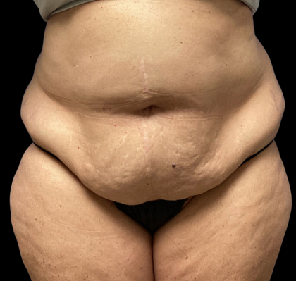 Tummy Tuck Before & After Patient #4728