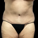 Tummy Tuck Before & After Patient #4728