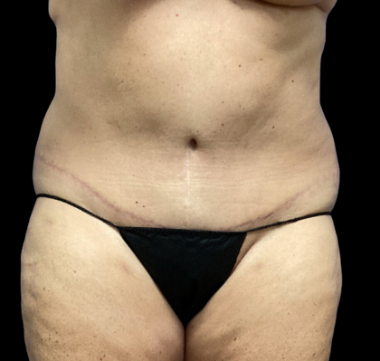 Tummy Tuck Before & After Patient #4728