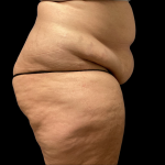 Tummy Tuck Before & After Patient #4728