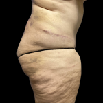 Tummy Tuck Before & After Patient #4728