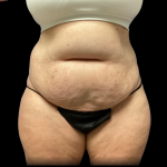 Tummy Tuck Before & After Patient #4729