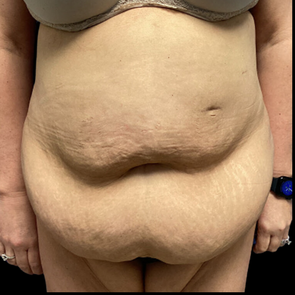 Tummy Tuck Before & After Patient #4719