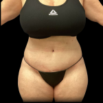 Tummy Tuck Before & After Patient #4729