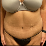 Tummy Tuck Before & After Patient #4719