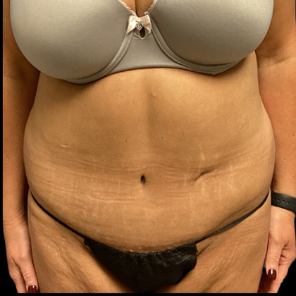 Tummy Tuck Before & After Patient #4719