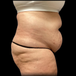 Tummy Tuck Before & After Patient #4729