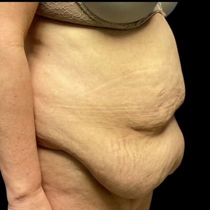 Tummy Tuck Before & After Patient #4719