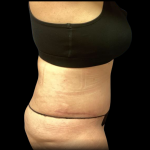 Tummy Tuck Before & After Patient #4729