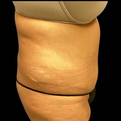 Tummy Tuck Before & After Patient #4719
