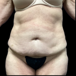 Tummy Tuck Before & After Patient #4721
