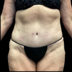 Tummy Tuck Before & After Patient #4721