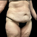 Tummy Tuck Before & After Patient #4721