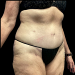 Tummy Tuck Before & After Patient #4721