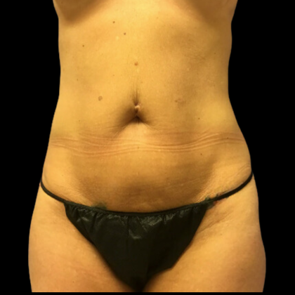 Tummy Tuck Before & After Patient #4722