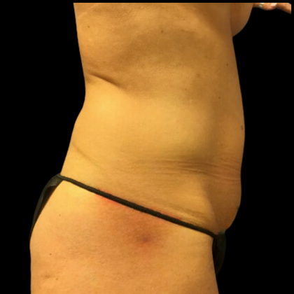 Tummy Tuck Before & After Patient #4722