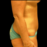Tummy Tuck Before & After Patient #4722