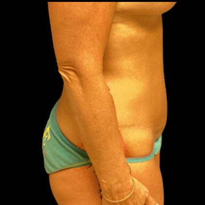 Tummy Tuck Before & After Patient #4722