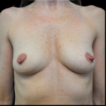 Breast Augmentation Before & After Patient #3977