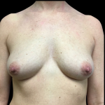 Breast Augmentation Before & After Patient #4021