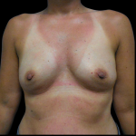 Breast Augmentation Before & After Patient #4022