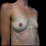 Breast Augmentation Before & After Patient #4024